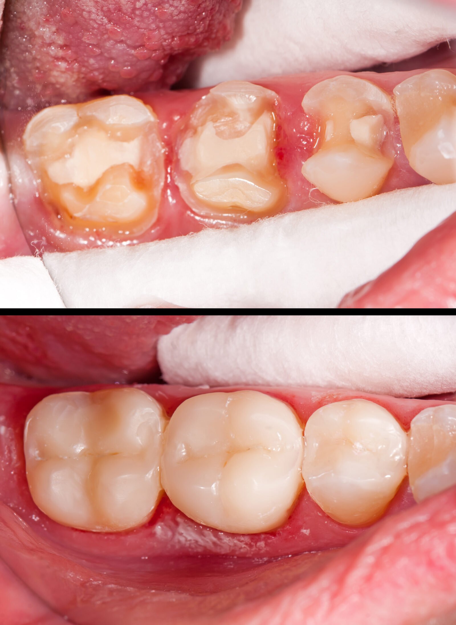 Onlay Or Crown: A Comprehensive Comparison For Tooth Repair