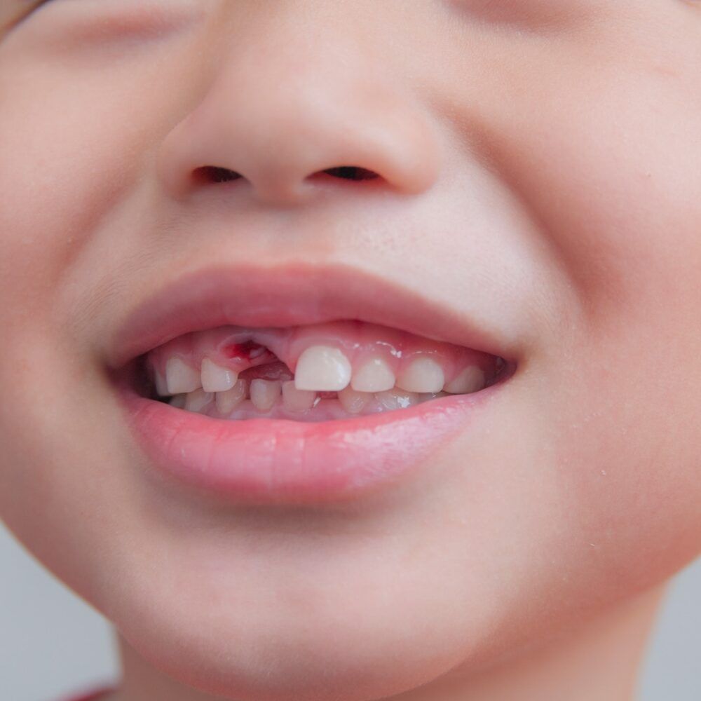 Closeup of missing tooth of a young kid after dental extraction