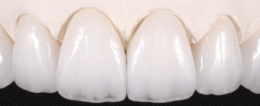 Upper front teeth closeup