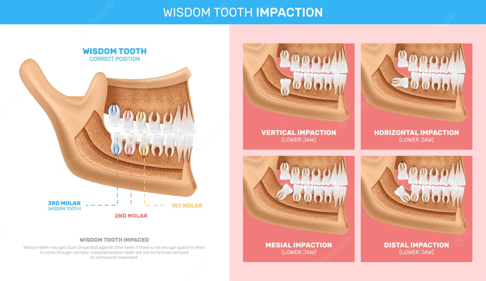 Diagram displaying different types of wisdom tooth impactions including a vertical impaction, a horizontal impcation, a mesial impaction, and a distal impcation