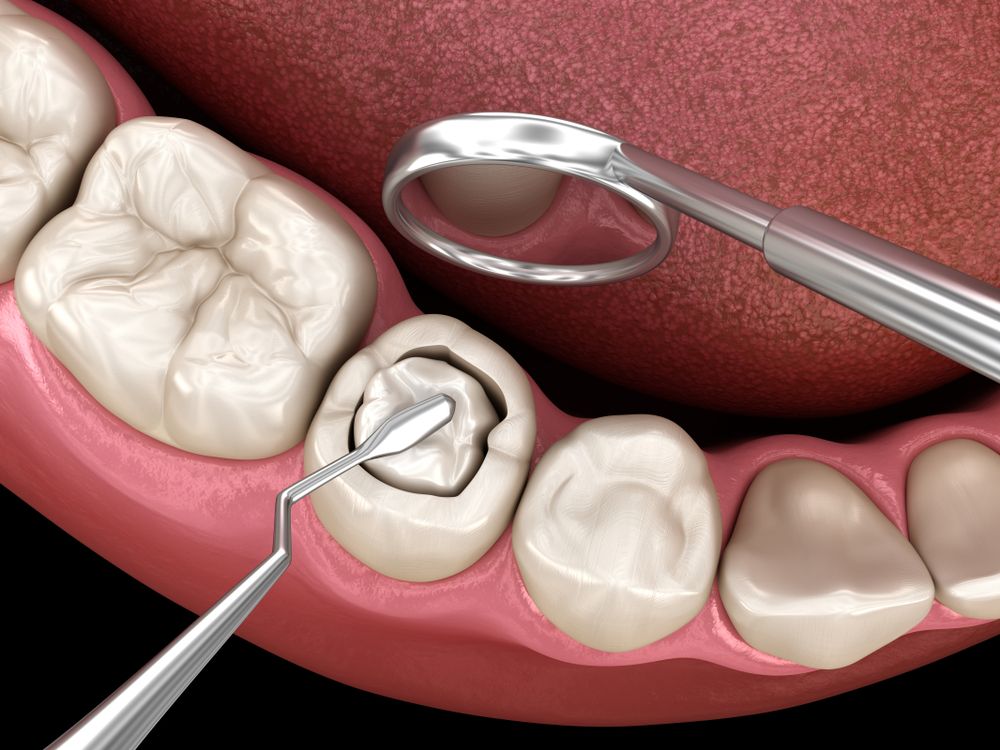 Tooth color composite filling being placed