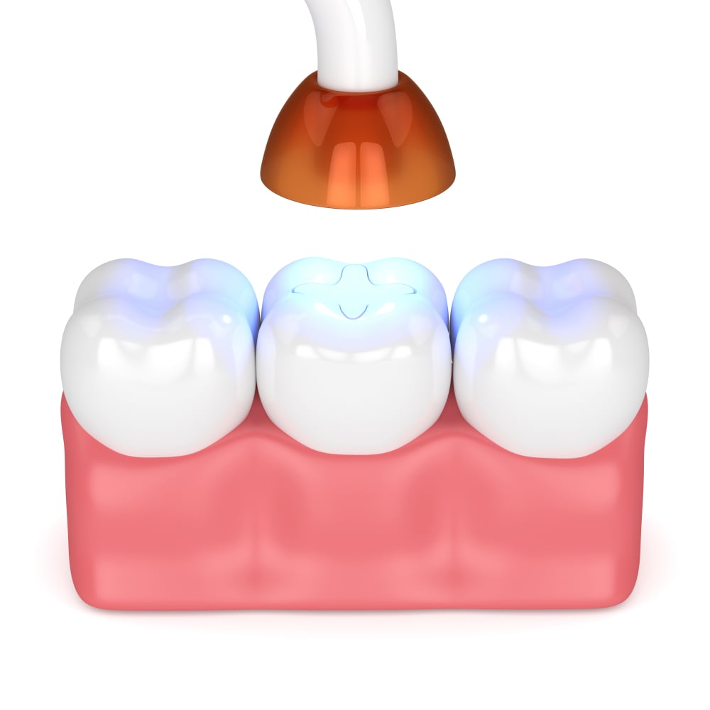 light curing a tooth