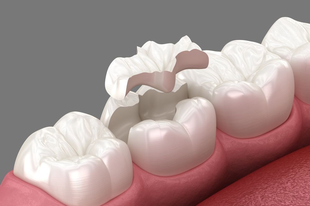 porcelain inlays before cementation with liners