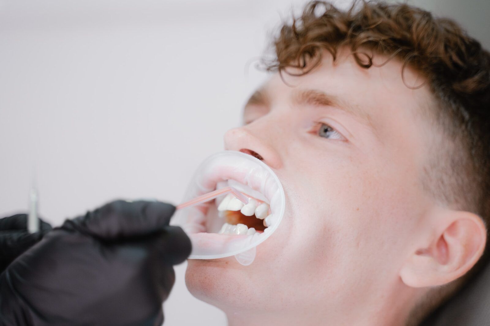 The hygienist doctor washes off the whitening solution from the teeth