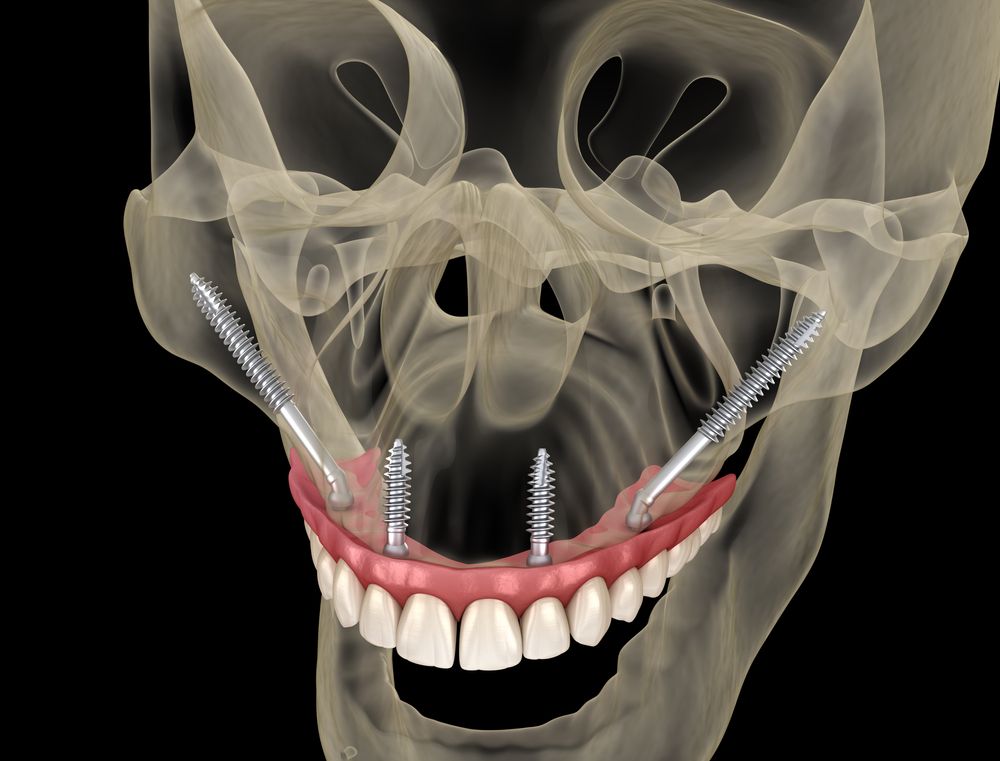 Zygomatic dental implant example