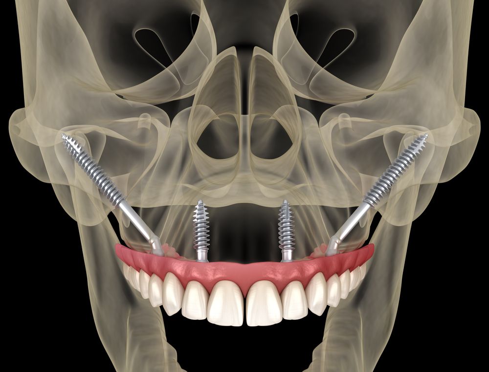 Maxillary,Prosthesis,Supported,By,Zygomatic,Implants.,Medically,Accurate,3d,Illustration