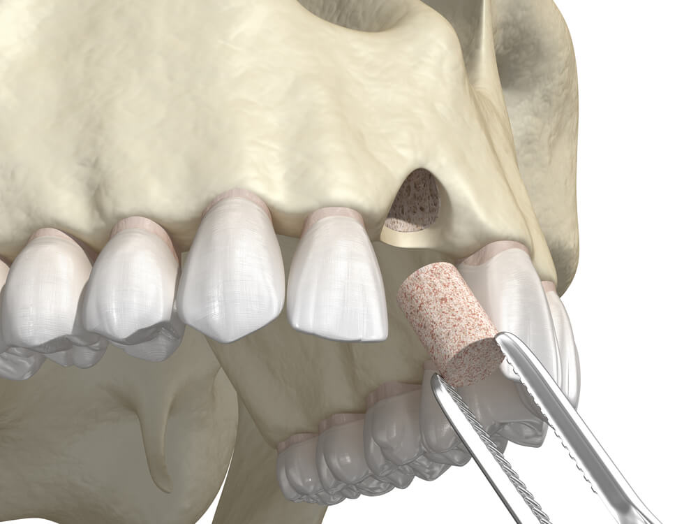 bone graft material