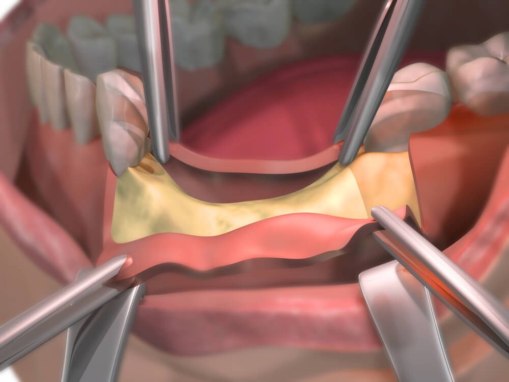 dental gum surgery