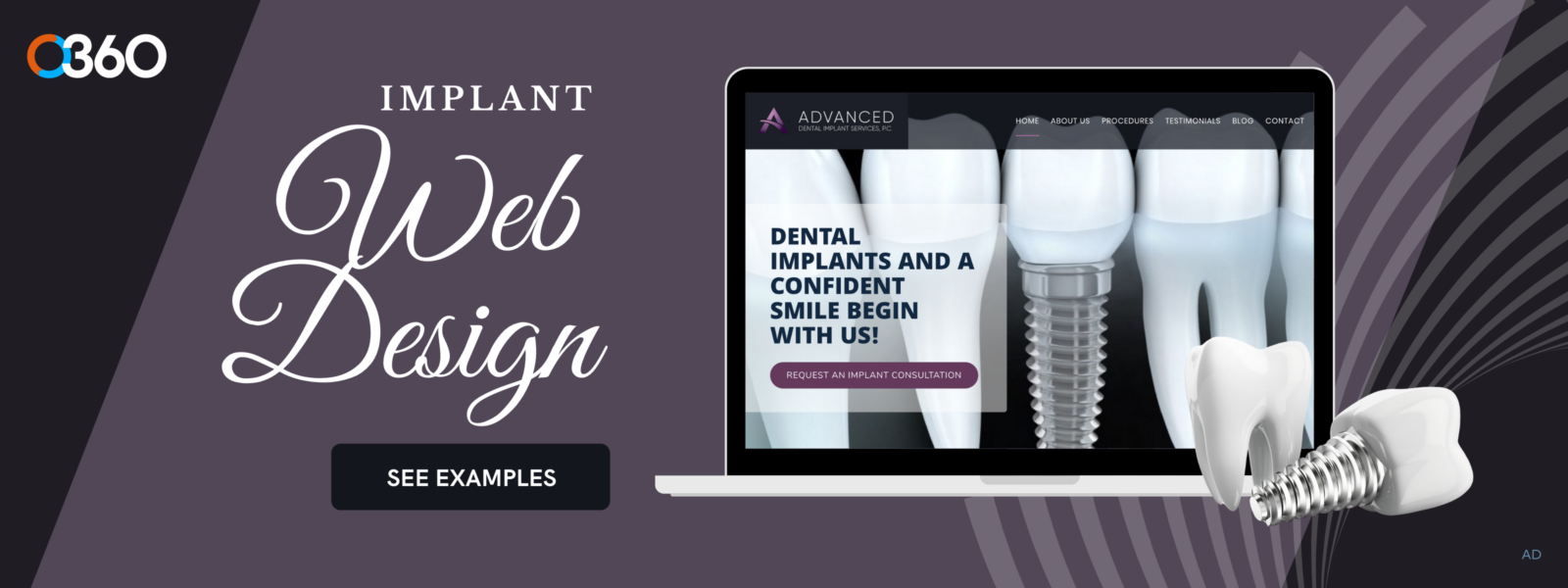 O360 ad - dental implant web design