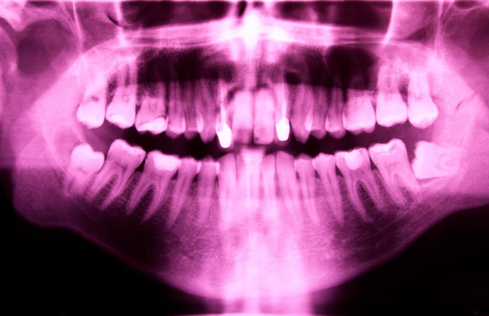 Dental X-ray showing multiple teeth including root resorption