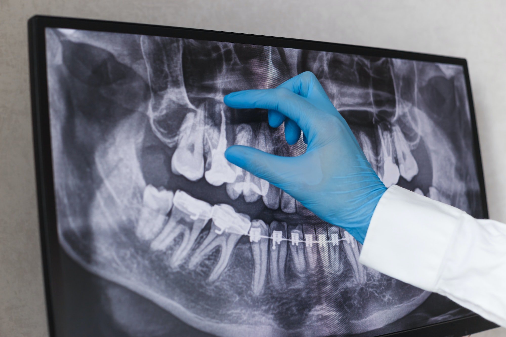 Doctor points to filled root canal in dental x-ray