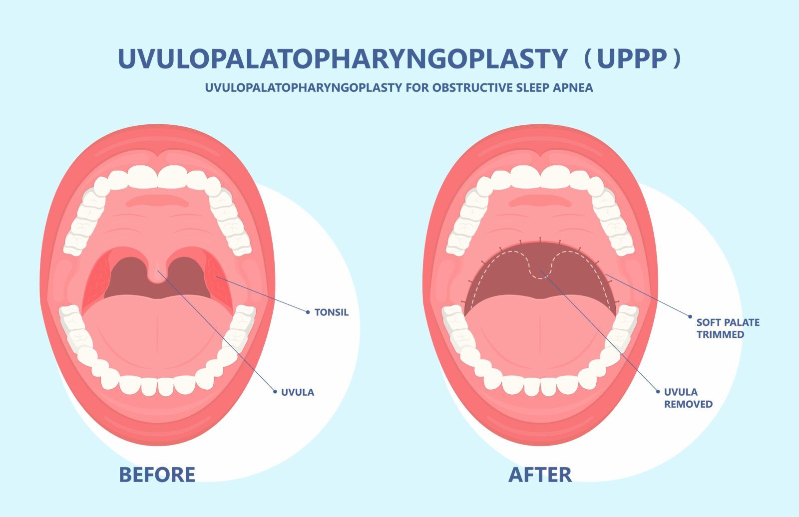 Somnoplasty for snoring before and after illustration