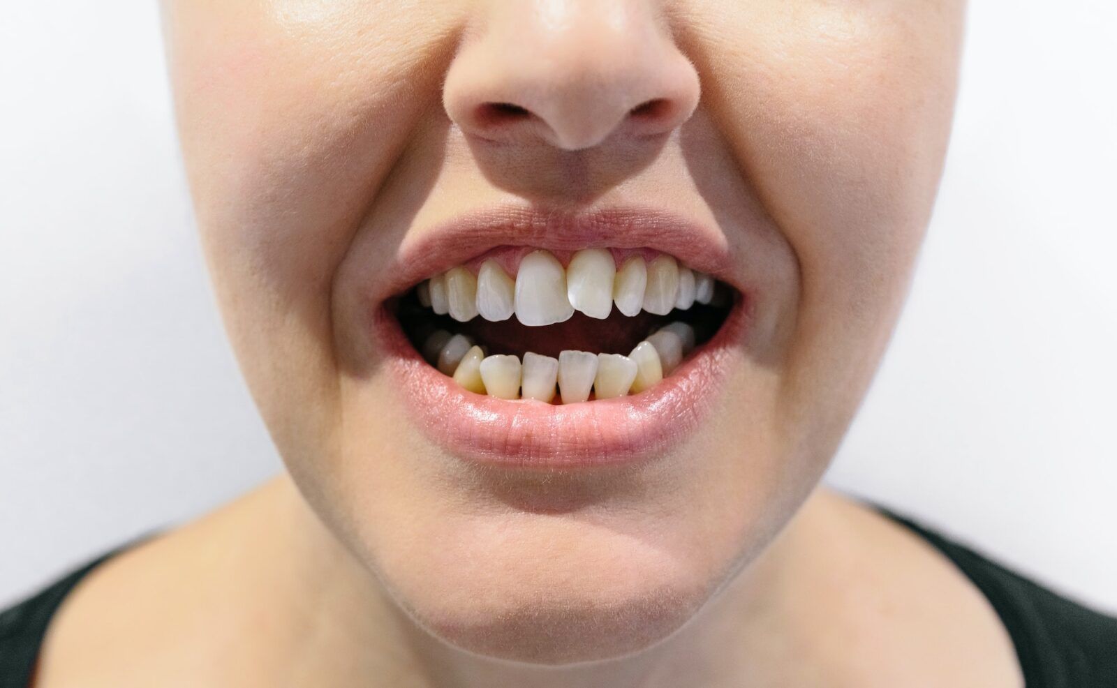 Woman open mouth with crooked teeth