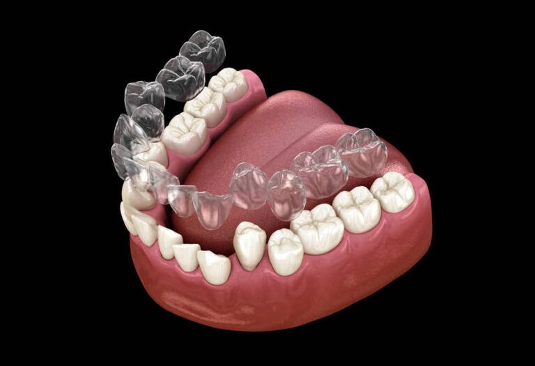 Clear aligner for teeth on a dental set